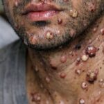 Goianésia registra caso suspeito de mpox e paciente está em isolamento domiciliar Goianésia registra caso suspeito de mpox e paciente está em isolamento domiciliar